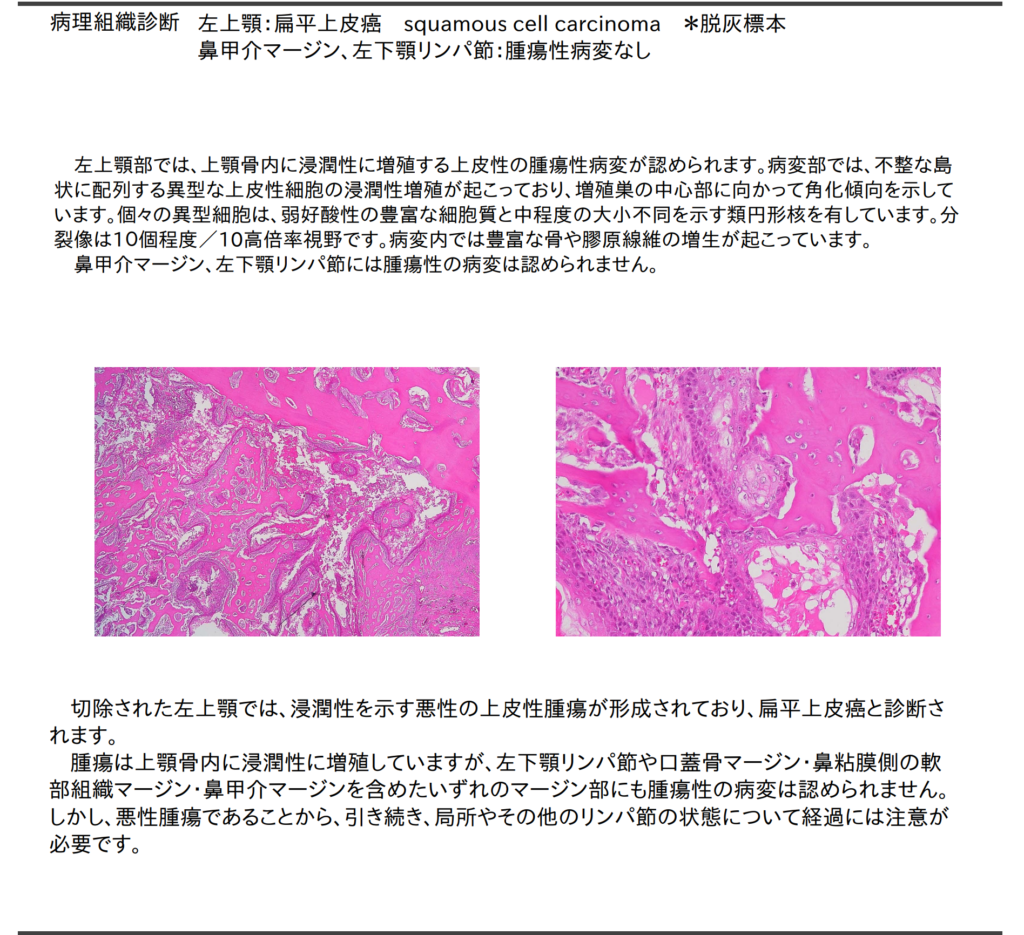 扁平上皮癌　病理結果