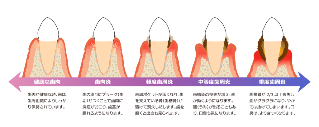 歯周病進行度