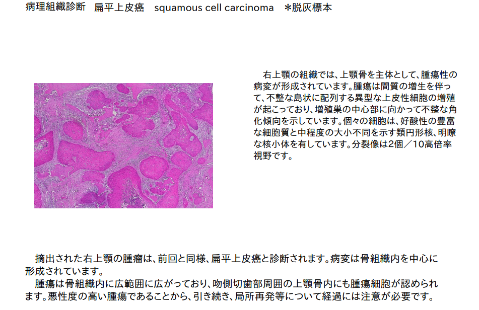 上顎扁平上皮癌　病理検査