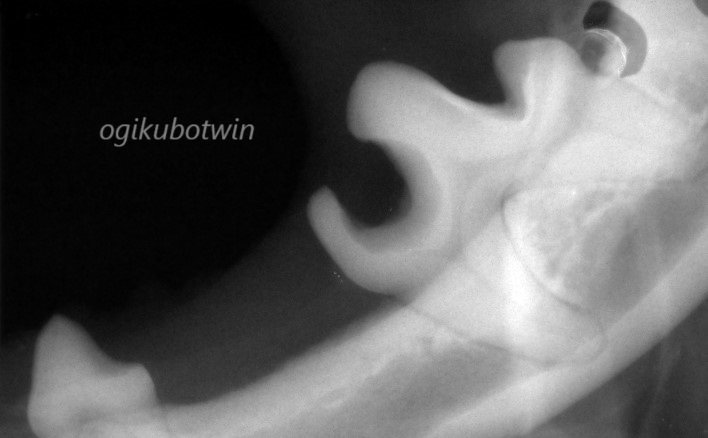 虫歯　下顎第一後臼歯　レントゲン　