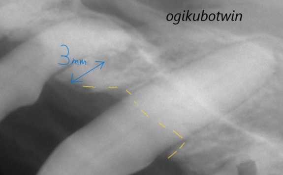 上顎犬歯再生治療　レントゲン