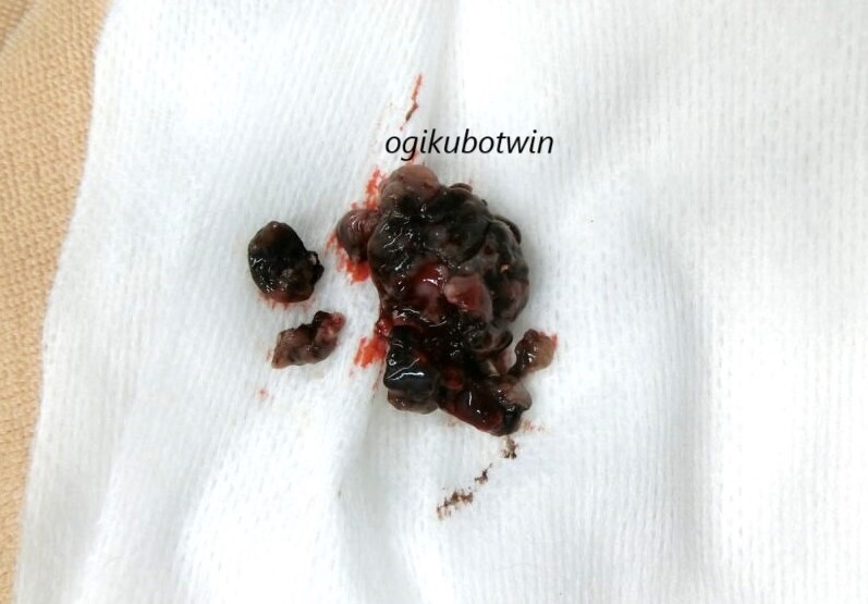 メラノーマ 切除