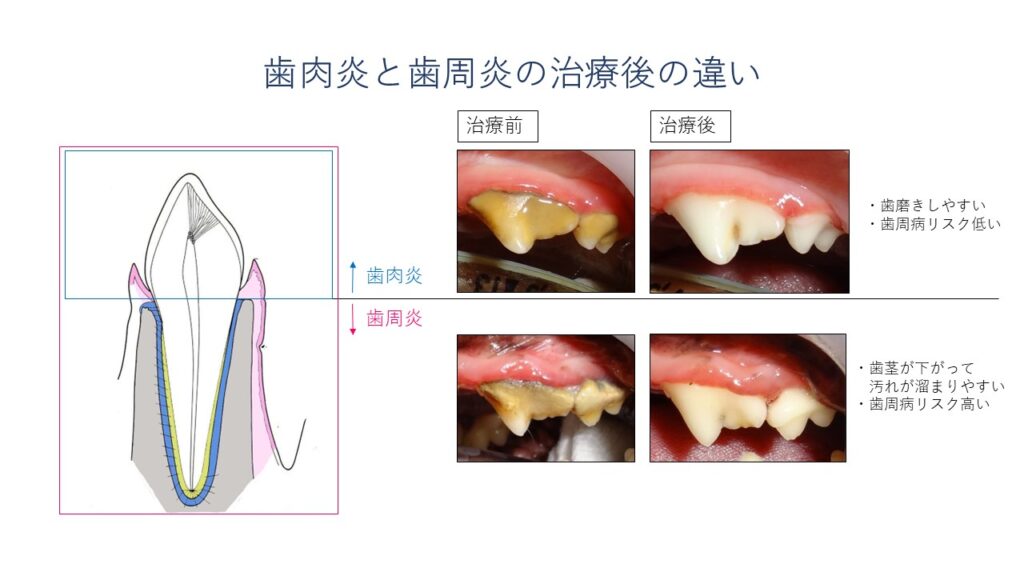 犬の歯周病　歯肉炎と歯周炎の違い