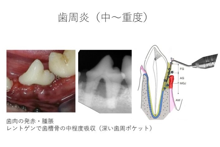 歯周炎　中程度