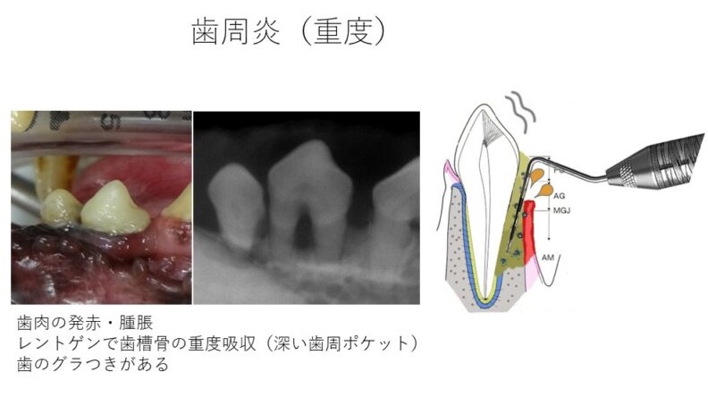 歯周炎　重度