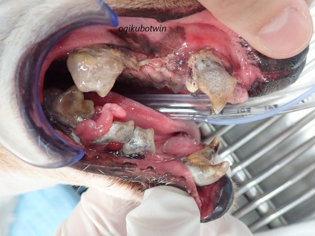 全抜歯 重度歯周病治療前