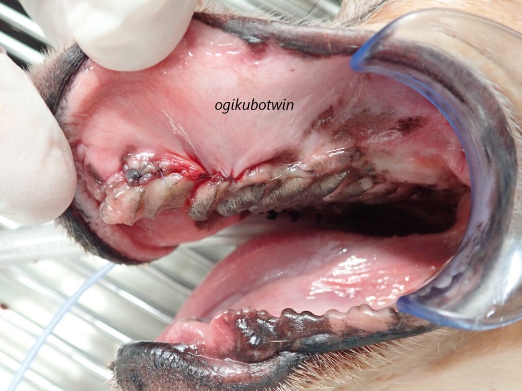 重度歯周病で全抜歯 治療後