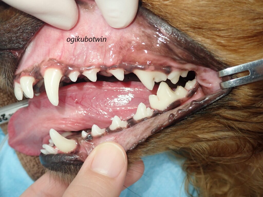 歯のクリーニング！軽度歯周病　治療後