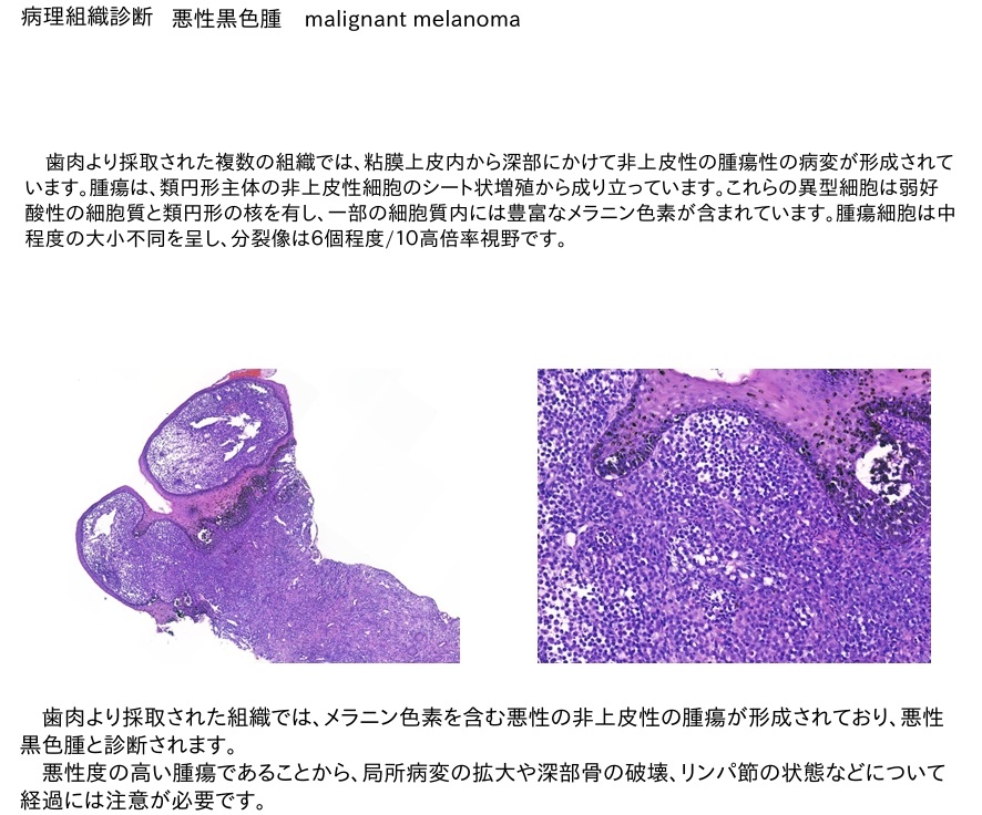 メラノーマ　病理検査