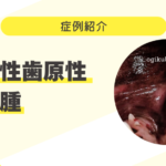 81_犬の周辺性歯原性線維腫