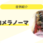犬は要注意!口腔内メラノーマ⑤ 83_犬の口腔内メラノーマ