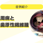 85_重度歯周病と周辺性歯原性線維腫