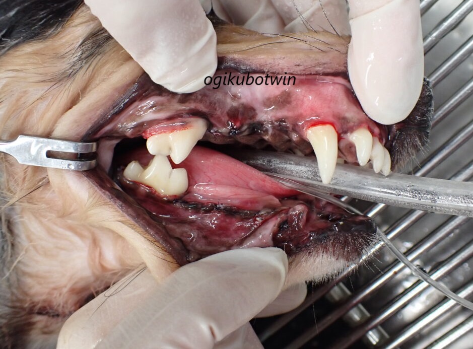 重度歯周病で顎骨骨折　