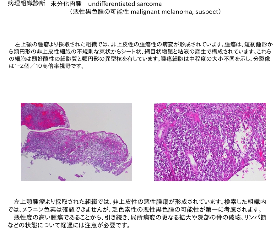 乏色素性メラノーマ(悪性黒色腫) 病理