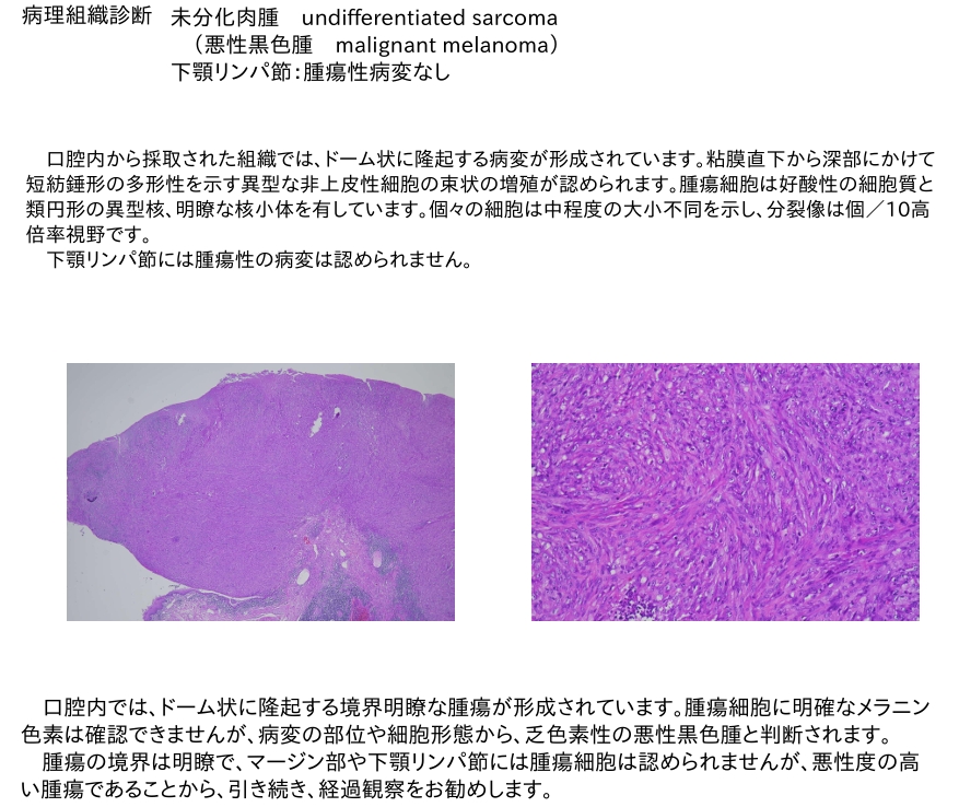 乏色素性メラノーマ(悪性黒色腫) 病理