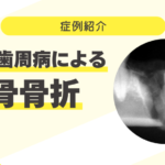 重度歯周病で顎骨骨折 79_重度歯周病による顎骨骨折