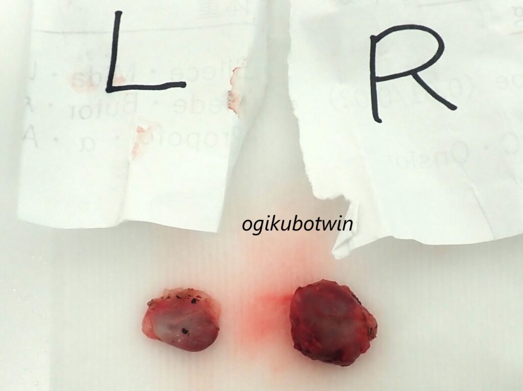 悪性上皮性腫瘍　犬　リンパ節