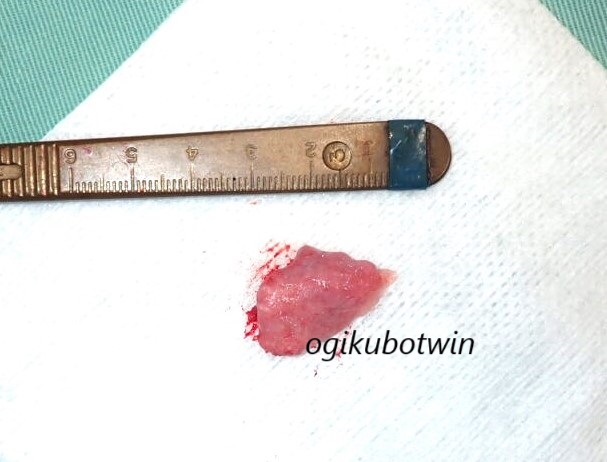 切除した軟口蓋