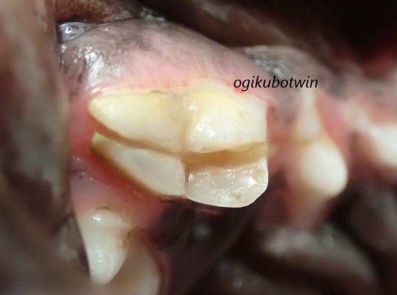 犬　破折　右側第四前臼歯