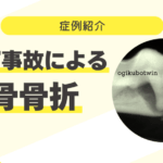 危険!落下事故による顎骨骨折 74_落下事故による顎骨骨折