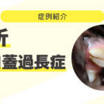 75_破折　軟口蓋過長症