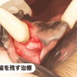 犬歯を残す治療｜歯を抜かずに治療！下顎犬歯の再生治療