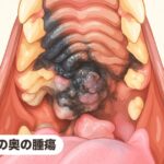 口の奥の腫瘍｜犬は要注意！口腔内メラノーマ⑤