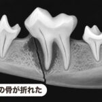 危険!落下事故による顎骨骨折 顎の骨が折れた|危険!落下事故による顎骨骨折