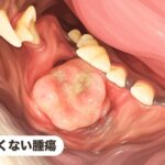 黒くない腫瘍｜乏色素性メラノーマ（悪性黒色腫）