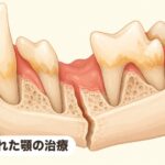 重度歯周病で顎骨骨折 折れた顎の治療|重度歯周病で顎骨骨折