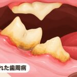 犬と猫の歯科検診のすすめ|見た目正常でも歯周病が進んでいる理由 隠れた歯周病|犬と猫の歯科検診のすすめ|見た目正常でも歯周病が進んでいる理由