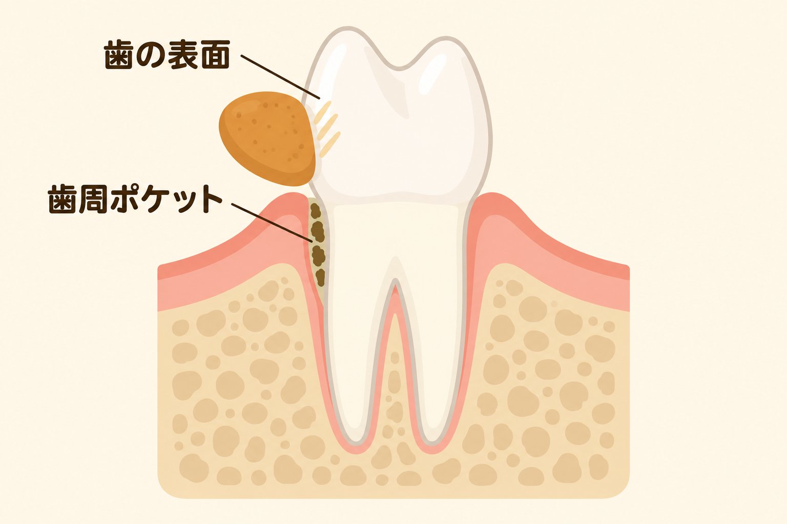イラスト:デンタルフードが届く歯の表面と、届かない歯周ポケットの模式図
